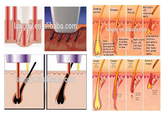 Mesin Penghilang Rambut IPL Permanen 2000w 950nm