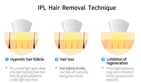 2000w OPT IPL+ 808NM DIODE LASER teknologi untuk peralatan hair removal